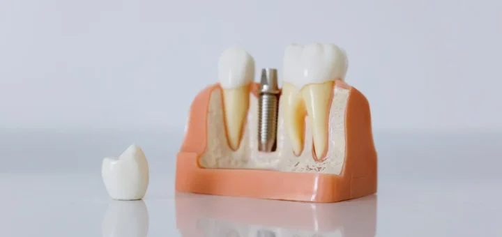Die 10 besten Unternehmen für Zahnimplantate